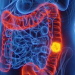 Cancer de colon novo estudo mostra que mudancas na dieta