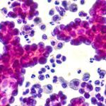 As proteinas spike da COVID ajudam as celulas do cancer